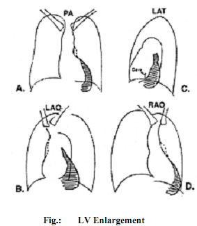 1793_Left Ventricle Enlargement.png